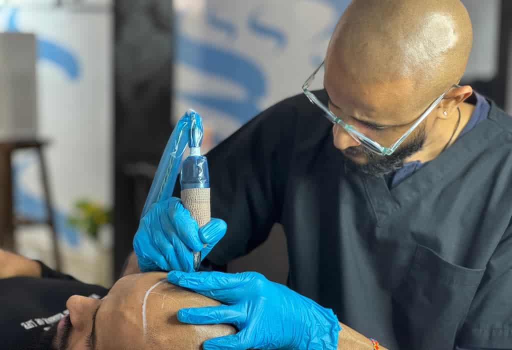 Scalp Micropigmentation In Bangalore